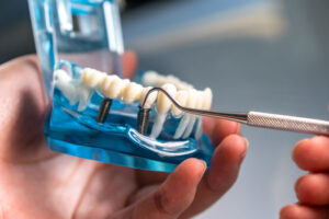 close-up of a dental implant model being held by a hand. The model shows a clear plastic jaw with a set of white teeth. One of the teeth has a metal dental implant installed in it, and a tool, likely