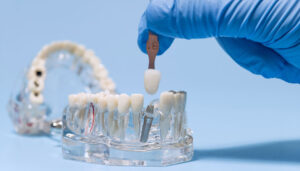 Dental implant color matching with shade guide, blue background dental office, dentist has blue gloves