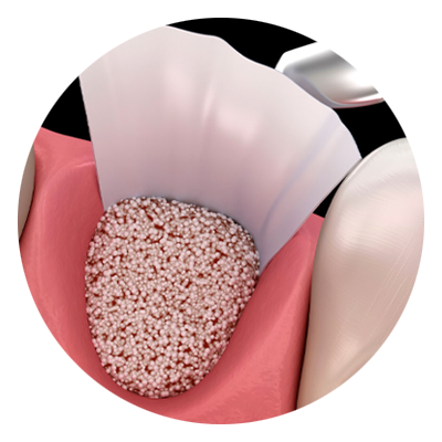 bone graft material being placed