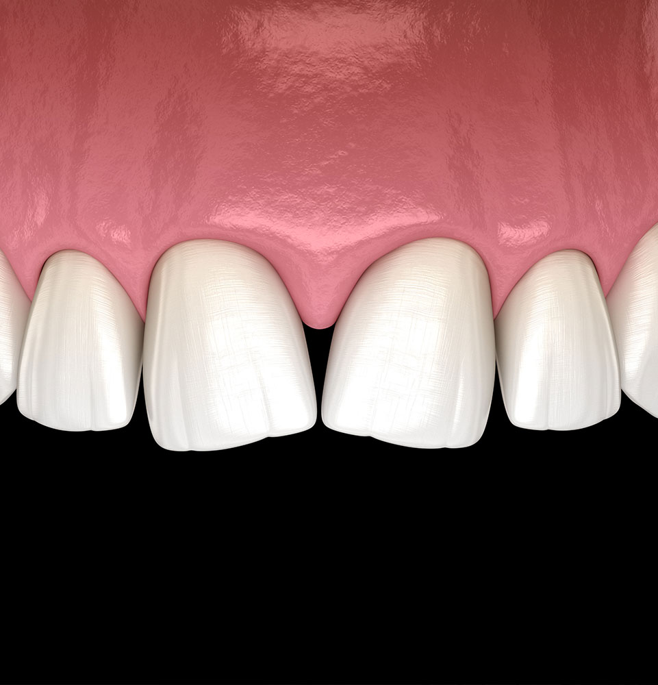 dental veneers candidate
