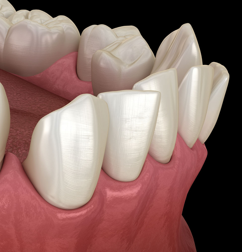 crooked teeth invisalign
