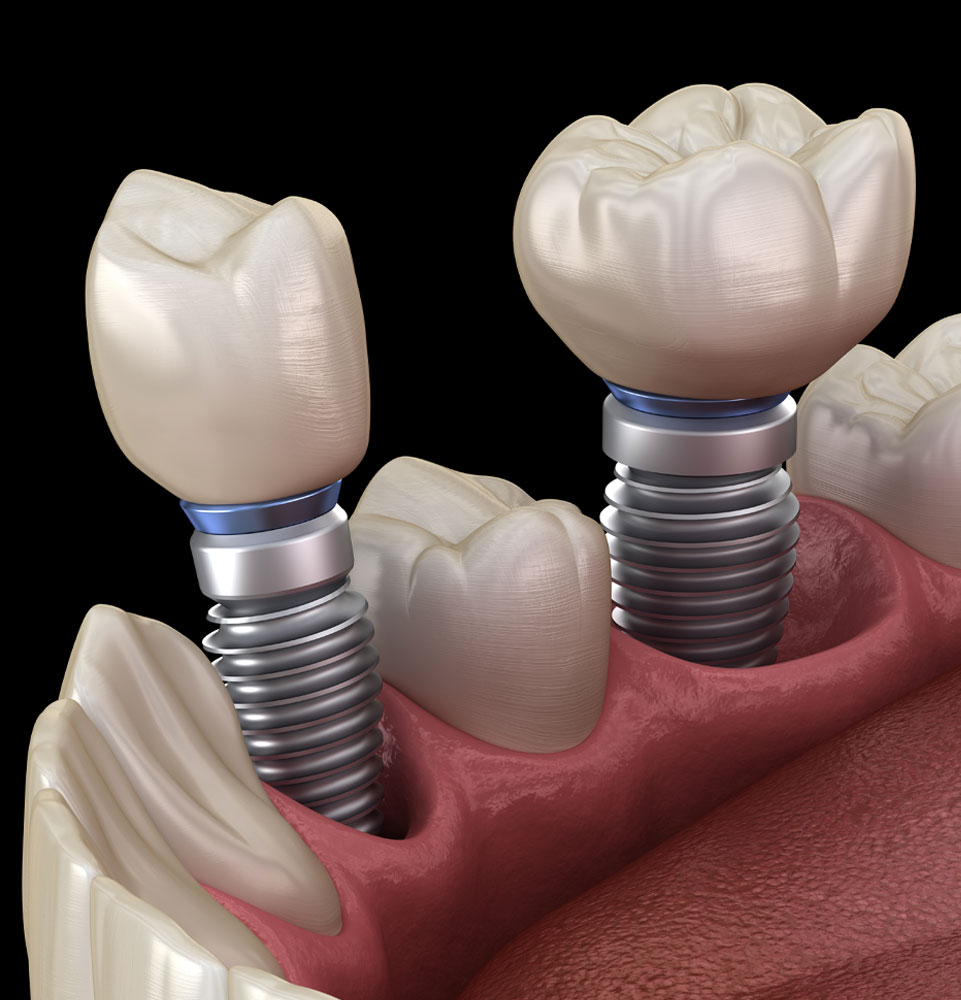 dental implants 3dmodel