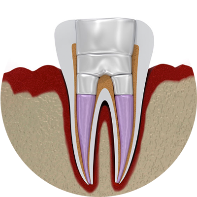 endodontic treatment 3dmodel