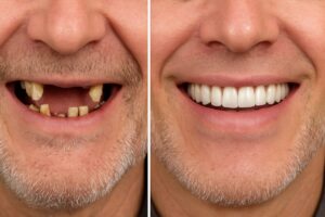 Image showcasing a before-and-after transformation of a patient's smile with a full set of dental implants. The "before" side shows missing or damaged teeth, while the "after" side displays a complete