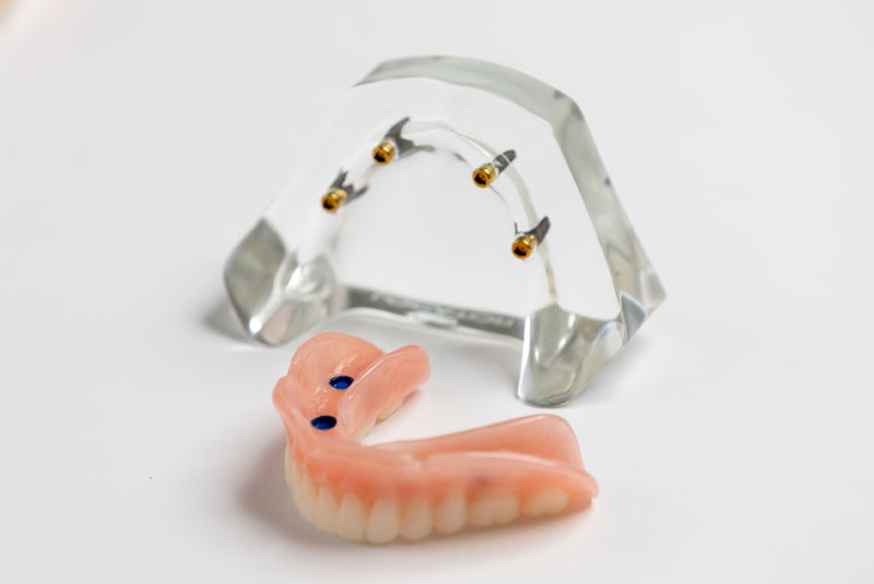 immediate denture model