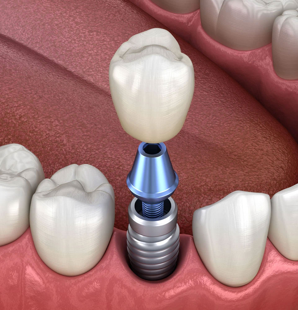 implant 3d model