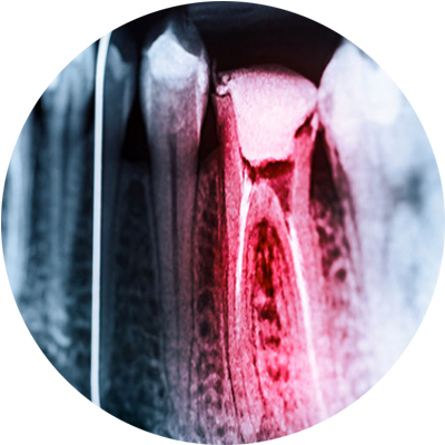 root canal xray circle