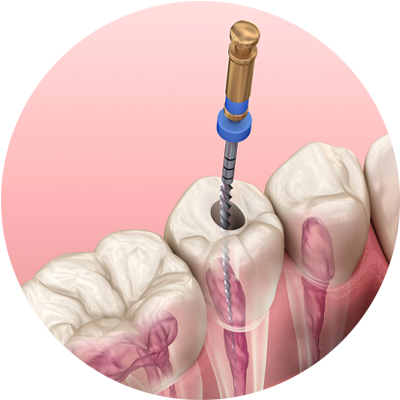 root canal procedure apicoectomy 3dmodel2