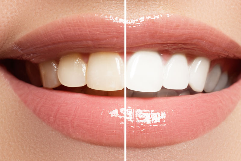 teeth whitening before and after