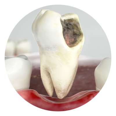 tooth extraction 3d model